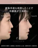 忘れ鼻整形 30日後 サムネイル用