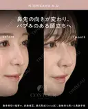 忘れ鼻整形 30日後 サムネイル用