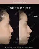 忘れ鼻整形 30日後 サムネイル用
