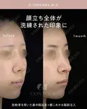 忘れ鼻整形 30日後 サムネイル用