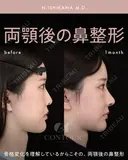 忘れ鼻整形 before画像 サムネイル用