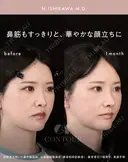 忘れ鼻整形 30日後 サムネイル用