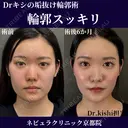 頬下脂肪吸引で輪郭スッキリ✨ 180日後 サムネイル用