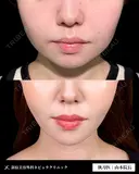 脂肪吸引で口横すっきり✨ before画像 サムネイル用