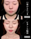 脂肪吸引で口横すっきり✨ after画像 サムネイル用