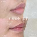 加賀デザイン×口唇縮小(上下) after画像 サムネイル用