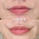 加賀デザイン×口角挙上 before画像 サムネイル用
