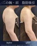 二の腕＋肩脂肪吸引 after画像 サムネイル用