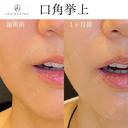 口角挙上 before画像 サムネイル用