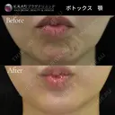 ボトックス注射（顎） after画像 サムネイル用