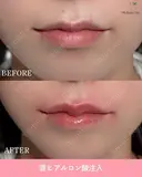 唇ヒアルロン酸 after画像 サムネイル用