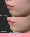 唇ヒアルロン酸 before画像 サムネイル用