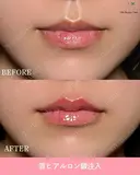 唇ヒアルロン酸 before画像 サムネイル用