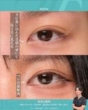 傷跡の目立たない目頭切開 14日後 サムネイル用