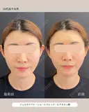 糸リフト・ショートスレッド・ヒアルロン酸 before画像 サムネイル用