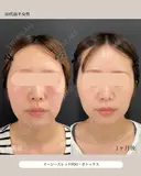 糸リフト・ボトックス after画像 サムネイル用