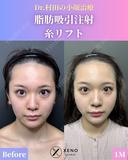 脂肪吸引注射（頬＋顎下＋ジョール）＋糸リフト＋頬・唇ヒアルロン酸 before画像 サムネイル用