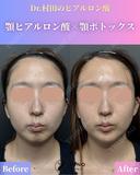 顎ヒアルロン酸＆顎ボトックス before画像 サムネイル用