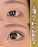 二重埋没+瞼の脂肪取り before画像 サムネイル用