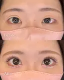 二重埋没+瞼の脂肪取り after画像 サムネイル用