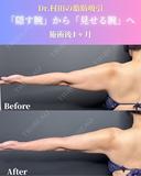 二の腕＋肩＋脇肉＋副乳　脂肪吸引 30日後 サムネイル用