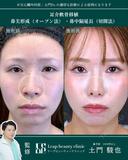 耳介軟骨移植・鼻尖形成・鼻中隔延長 before画像 サムネイル用