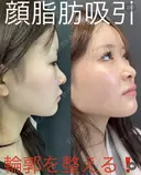 顔　脂肪吸引 after画像 サムネイル用