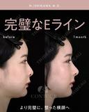 忘れ鼻整形 30日後 サムネイル用