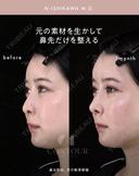 忘れ鼻整形 30日後 サムネイル用