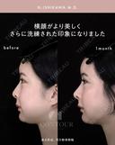 忘れ鼻整形 30日後 サムネイル用