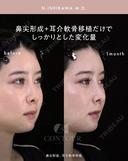 忘れ鼻整形 30日後 サムネイル用