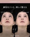 忘れ鼻整形 30日後 サムネイル用