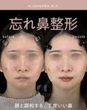 忘れ鼻整形 before画像 サムネイル用