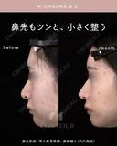 忘れ鼻整形 90日後 サムネイル用