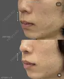 メンズ人中短縮術1ヶ月経過✨ before画像 サムネイル用