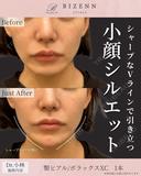 唇　😌ヒアルロン酸...	 before画像 サムネイル用