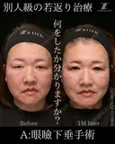 別人級の若返り治療 30日後 サムネイル用