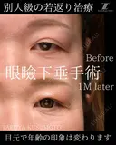 別人級の若返り治療 30日後 サムネイル用