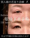 別人級の若返り治療 30日後 サムネイル用