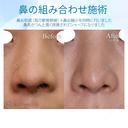 【20代女性・鼻先をスッキリ】鼻尖縮小＋耳介軟骨移植（1ヵ月後） before画像 サムネイル用
