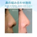 【20代女性・鼻先をスッキリ】鼻尖縮小＋耳介軟骨移植（1ヵ月後） after画像 サムネイル用
