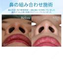 【20代女性・鼻先をスッキリ】鼻尖縮小＋耳介軟骨移植（1ヵ月後） after画像 サムネイル用