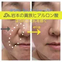 貴族ヒアルロン酸 before画像 サムネイル用