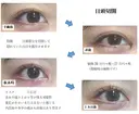 目頭切開 31日後 サムネイル用