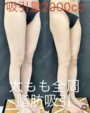 太もも全周脂肪吸引　アキーセル使用 after画像 サムネイル用