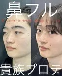 鼻フル　貴族プロテーゼ before画像 サムネイル用