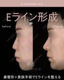 忘れ鼻整形 390日後 サムネイル用