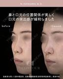 忘れ鼻整形 390日後 サムネイル用