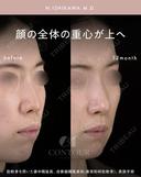 忘れ鼻整形 390日後 サムネイル用