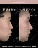 忘れ鼻整形 390日後 サムネイル用